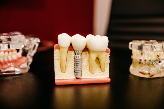 Implanty zębów – od czego zależy cena