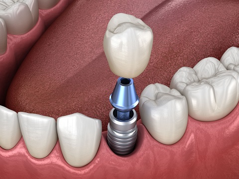 Korona na implantach Implanty zębów Szczecin