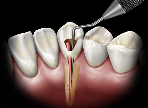 Leczenie kanalowe dentysta szczecin
