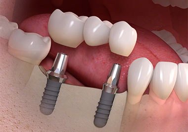Most na implantach Implanty zębów Szczecin