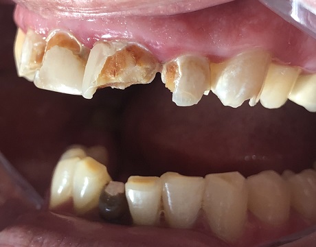 Pogotowie stomatologiczne Szczecin Uraz zęba