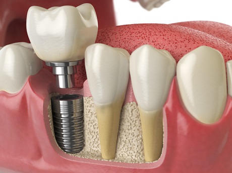 Pojedynczy implant Implanty zębów Szczecin