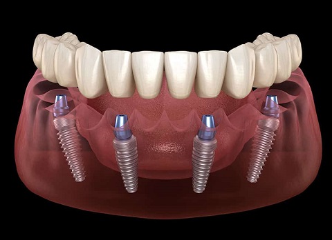 Proteza na implantach Implanty zębów Szczecin