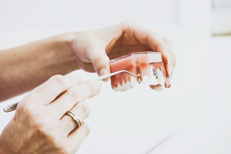 Kiedy warto rozważyć wszczepienie implantów zębów
