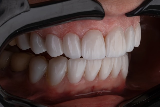 Implanty zębów czy licówki