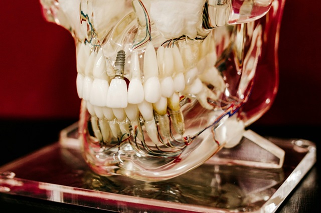 Korzyści płynące z implantów zębów