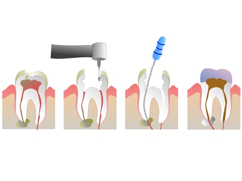 Endodoncja Szczecin Reendo