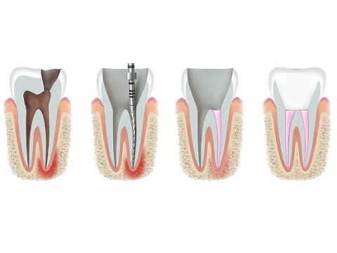 Endodoncja Szczecin mikroskop