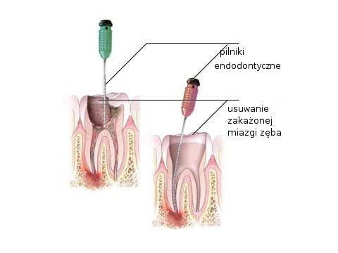 Leczenie kanałowe zębów Szczecin klasyczne